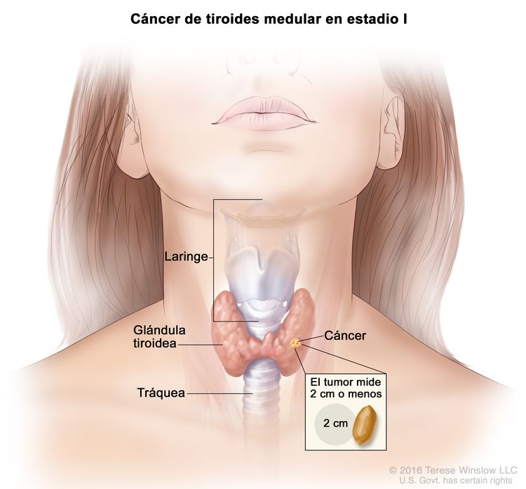 Cáncer de tiroides medular en estadio I. En la imagen se muestra cáncer en la glándula tiroidea y el tumor que mide 2 cm o menos. En el recuadro se observa que 2 cm es casi del tamaño de un maní. También se muestran la laringe y la tráquea.