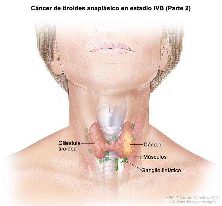 Cáncer de tiroides anaplásico en estadio IVB (Parte 2). En la imagen se muestra el cáncer en la glándula tiroidea y los músculos cercanos del cuello. También se muestran los ganglios linfáticos.