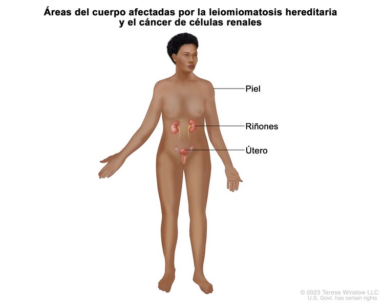 En la imagen se observan las áreas del cuerpo afectadas por la leiomiomatosis hereditaria y el cáncer de células renales, como la piel, los riñones y el útero. En la imagen se observan las áreas del cuerpo afectadas por la leiomiomatosis hereditaria y el cáncer de células renales, como la piel, los riñones y el útero.