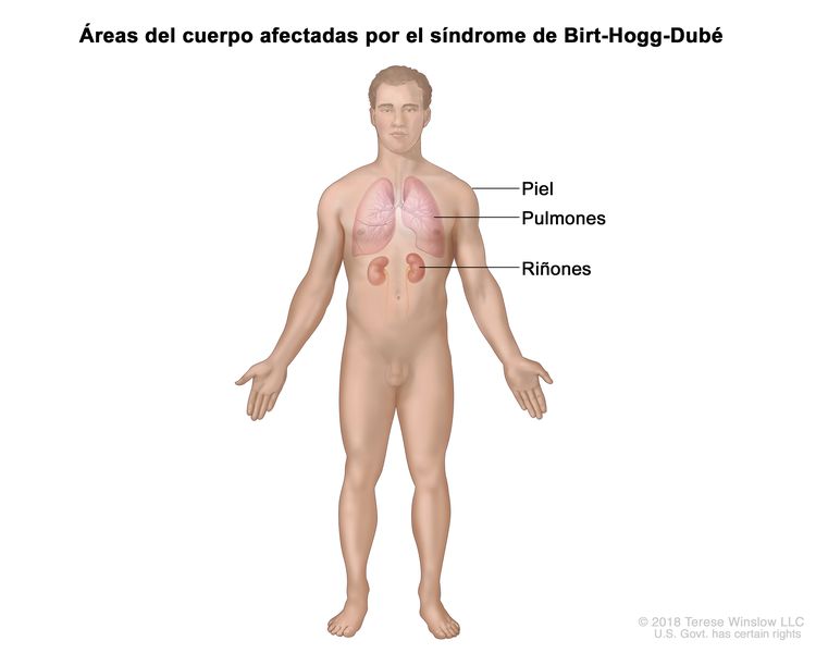 En la imagen se observan las áreas del cuerpo afectadas por el síndrome de Birt-Hogg-Dubé, como la piel, los pulmones y los riñones. En la imagen se observan las áreas del cuerpo afectadas por el síndrome de Birt-Hogg-Dubé, como la piel, los pulmones y los riñones.