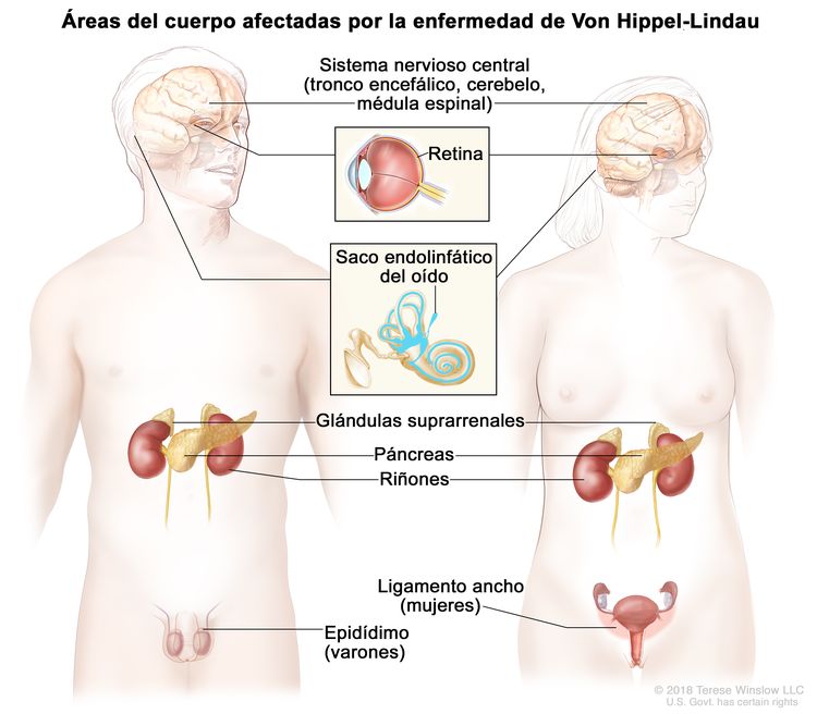 En la imagen se observan las siluetas del cuerpo de un hombre y de una mujer en las que se muestran las áreas del cuerpo afectadas por la enfermedad de Von Hippel-Lindau. Estas áreas son el sistema nervioso central (incluso el tronco encefálico, el cerebelo y la médula espinal), la retina, el saco endolinfático del oído, las glándulas suprarrenales, el páncreas, los riñones, el epidídimo (en varones) y el ligamento ancho (en mujeres). En la imagen se observan las siluetas del cuerpo de un hombre y de una mujer en las que se muestran las áreas del cuerpo afectadas por la enfermedad de Von Hippel-Lindau. Estas áreas son el sistema nervioso central (incluso el tronco encefálico, el cerebelo y la médula espinal), la retina, el saco endolinfático del oído, las glándulas suprarrenales, el páncreas, los riñones, el epidídimo (en varones) y el ligamento ancho (en mujeres).